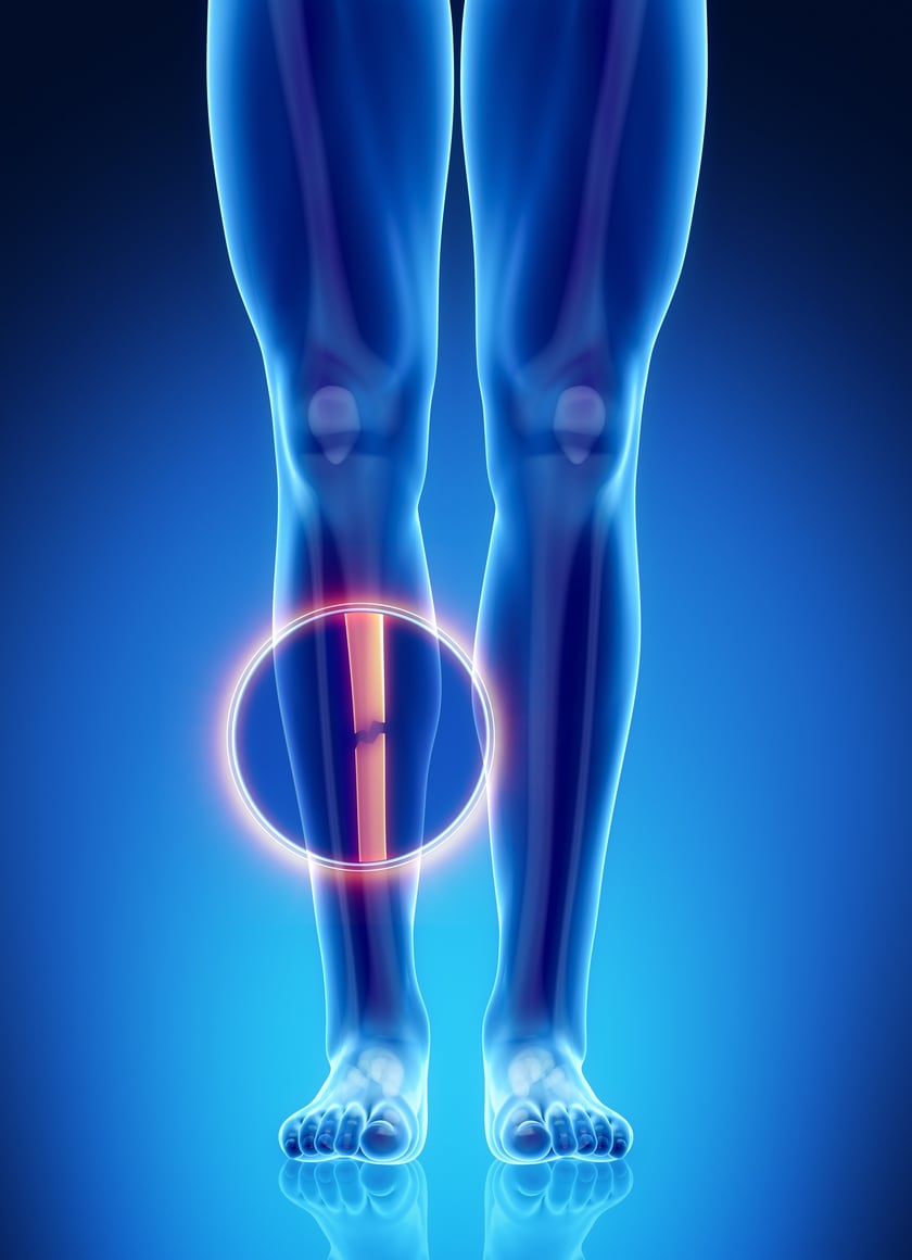 Male bone anatomy tibia broken